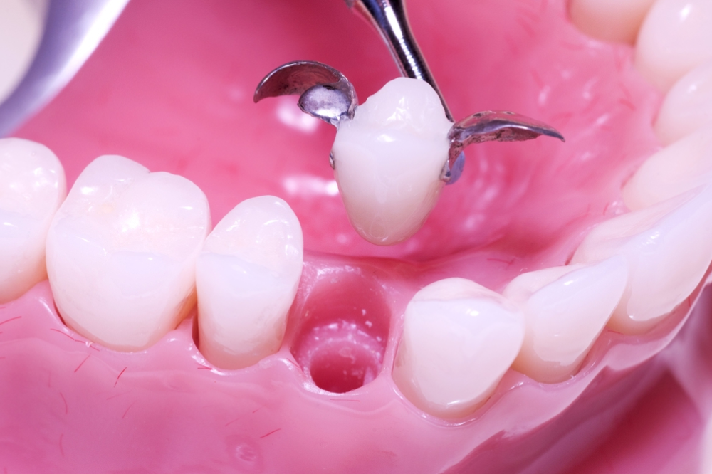 common dental bridge problems and how to avoid them