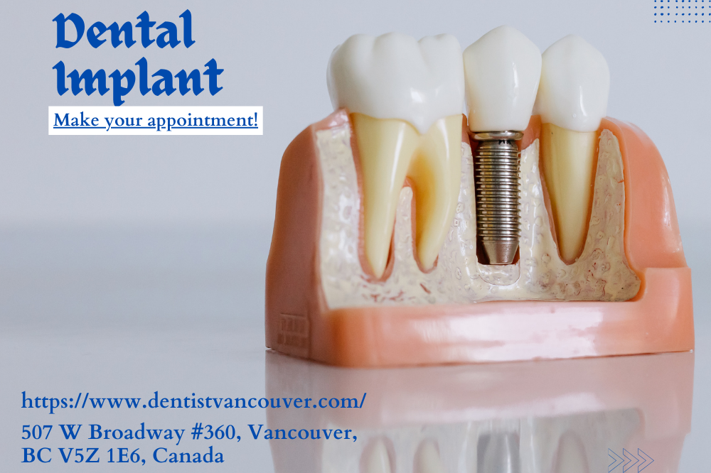 dental implants a permanent solution for missing teeth